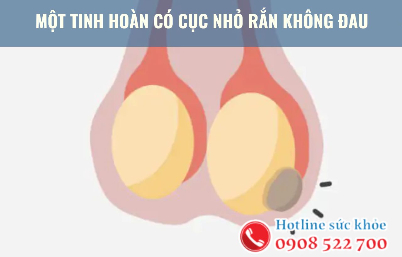 Một tinh hoàn có cục nhỏ rắn không đau có nguy hiểm không?