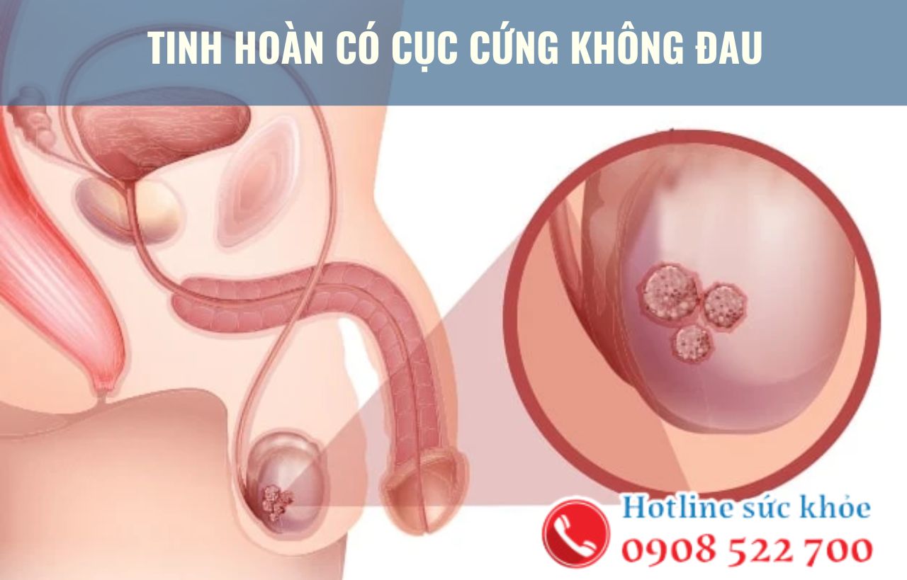 Tinh hoàn có cục cứng không đau là bệnh gì?