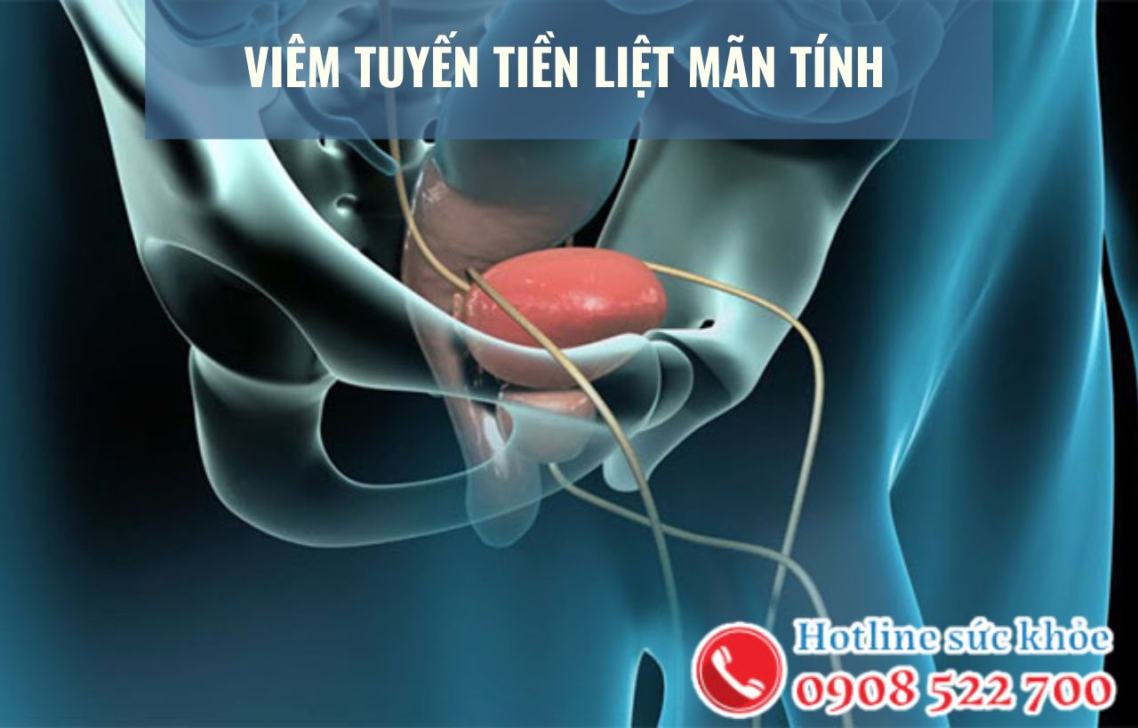 Viêm tuyến tiền liệt mãn tính có chữa khỏi không?