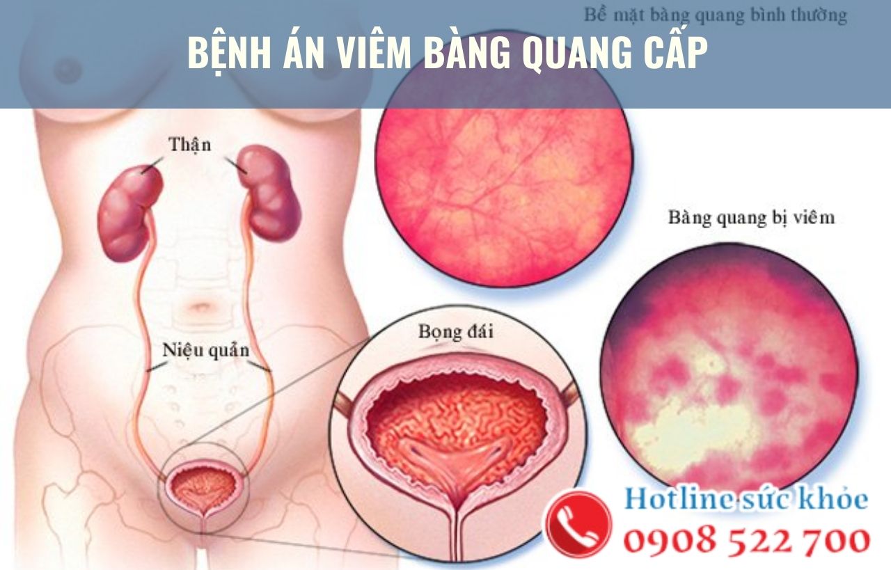 Bệnh án viêm bàng quang cấp có thể điều trị bằng cách nào?