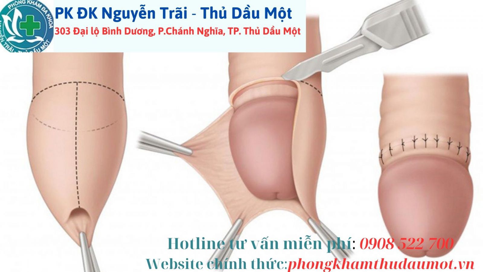 Chữa dứt điểm yếu sinh lý nam bằng phương pháp y tế tiên tiến, hiện đại