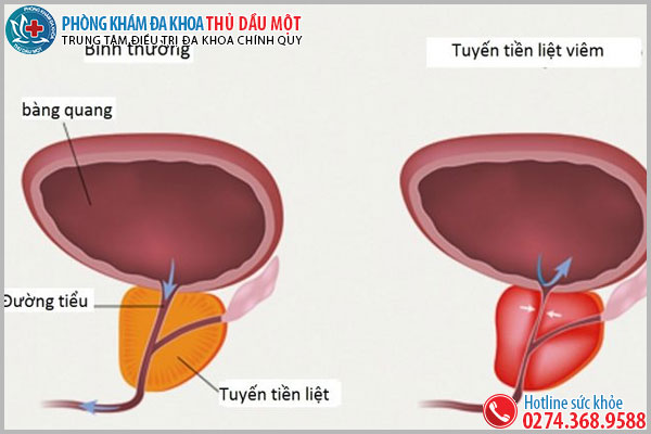 Hình ảnh viêm tuyến tiền liệt nam cần lưu ý