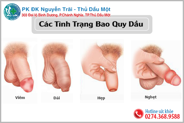 Các bệnh lý liên quan đến bao quy đầu thường gặp