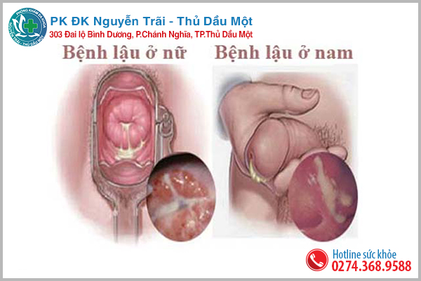 Dấu hiệu bệnh lậu ở nam và nữ giới cần lưu ý