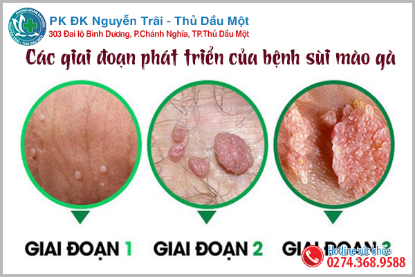 Dấu hiệu sùi mào gà thường gặp ở nam và nữ giới