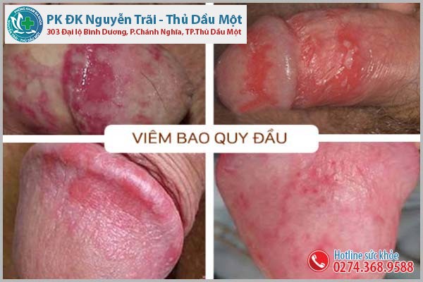 Viêm bao quy đầu căn bệnh “đau đầu” của nhiều anh em