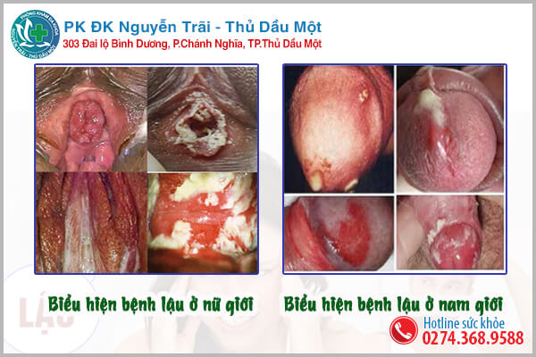 Hình ảnh bệnh lậu vùng kín ở nam và nữ giới