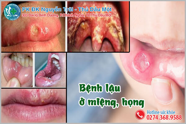 Hình ảnh bệnh lậu ở miệng, họng