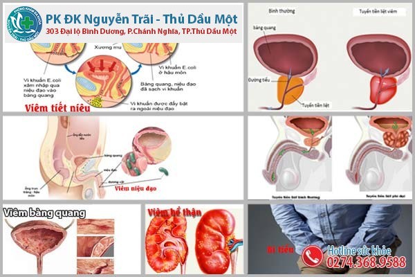 Tiểu buốt dấu hiệu nhận biết các bệnh lý nguy hiểm ở nam giới