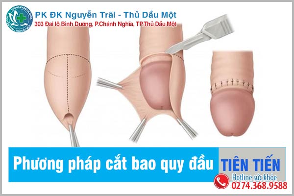 Tư vấn tổng quát về cắt bao quy đầu