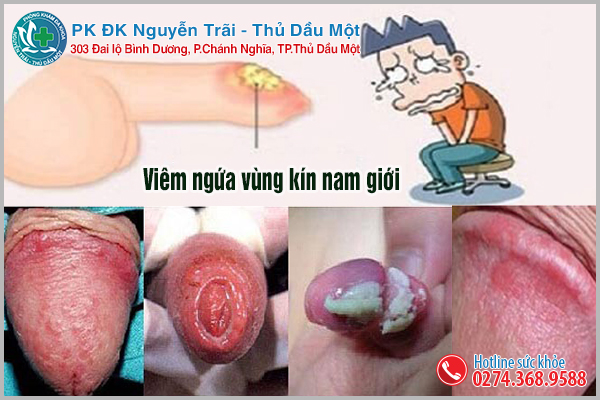 Dấu hiệu của những nốt mụn dương vật chỉ rõ bị viêm bao quy đầu