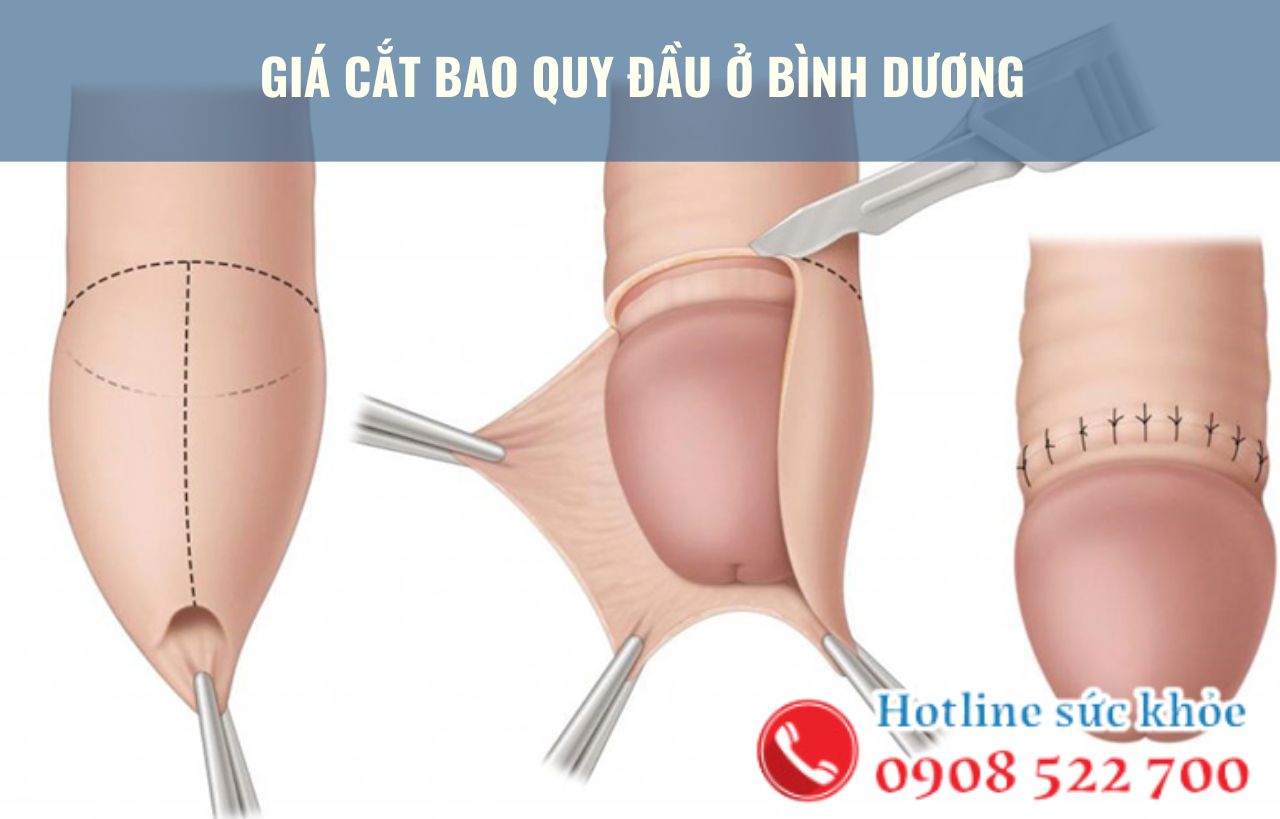 Giá cắt bao quy đầu ở Bình Dương có đắt không?