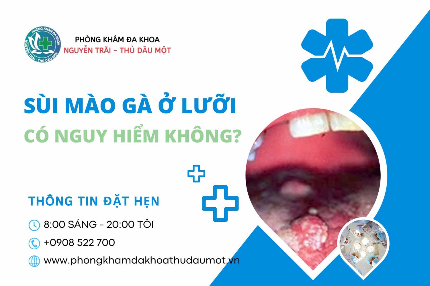 Bệnh sùi mào gà ở lưỡi có nguy hiểm không