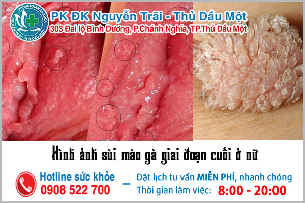 Hình ảnh sùi mào gà ở nữ giới giai đoạn cuối