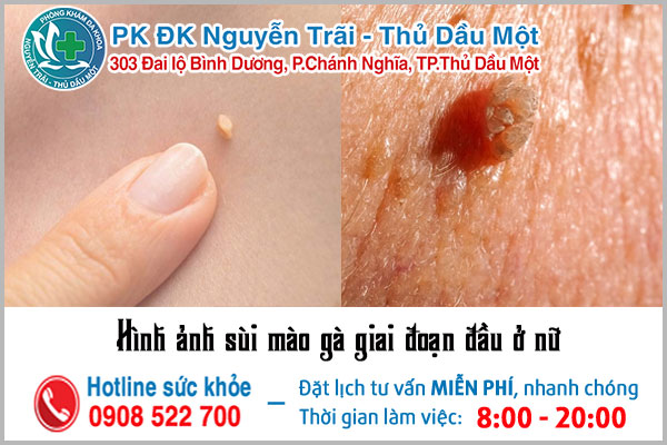 Hình ảnh sùi mào gà giai đoạn đầu ở nữ