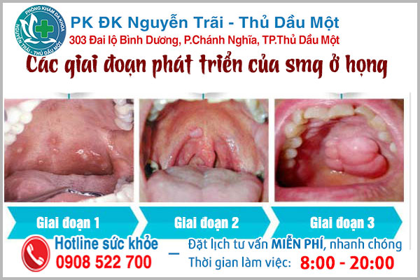 Hình ảnh sùi mào gà ở cổ họng