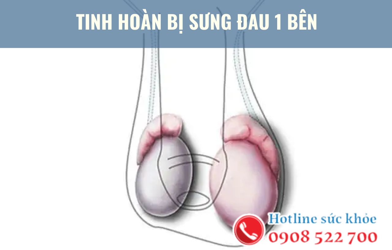 Tinh hoàn bị sưng đau 1 bên có điều trị được không?