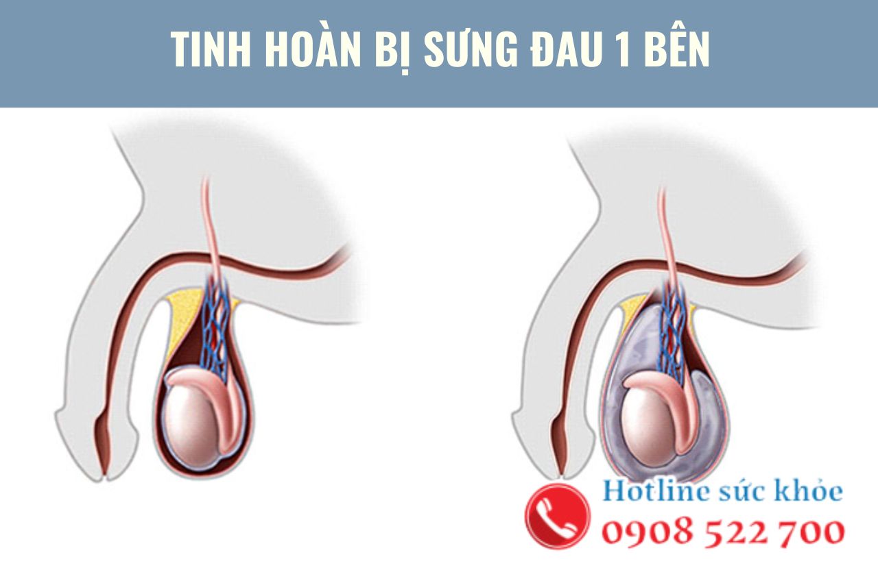 Tinh hoàn bị sưng đau 1 bên có điều trị được không?