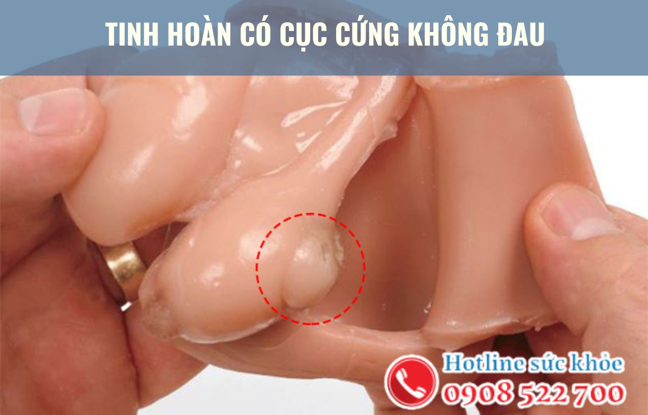 Tinh hoàn có cục cứng không đau là bệnh gì?