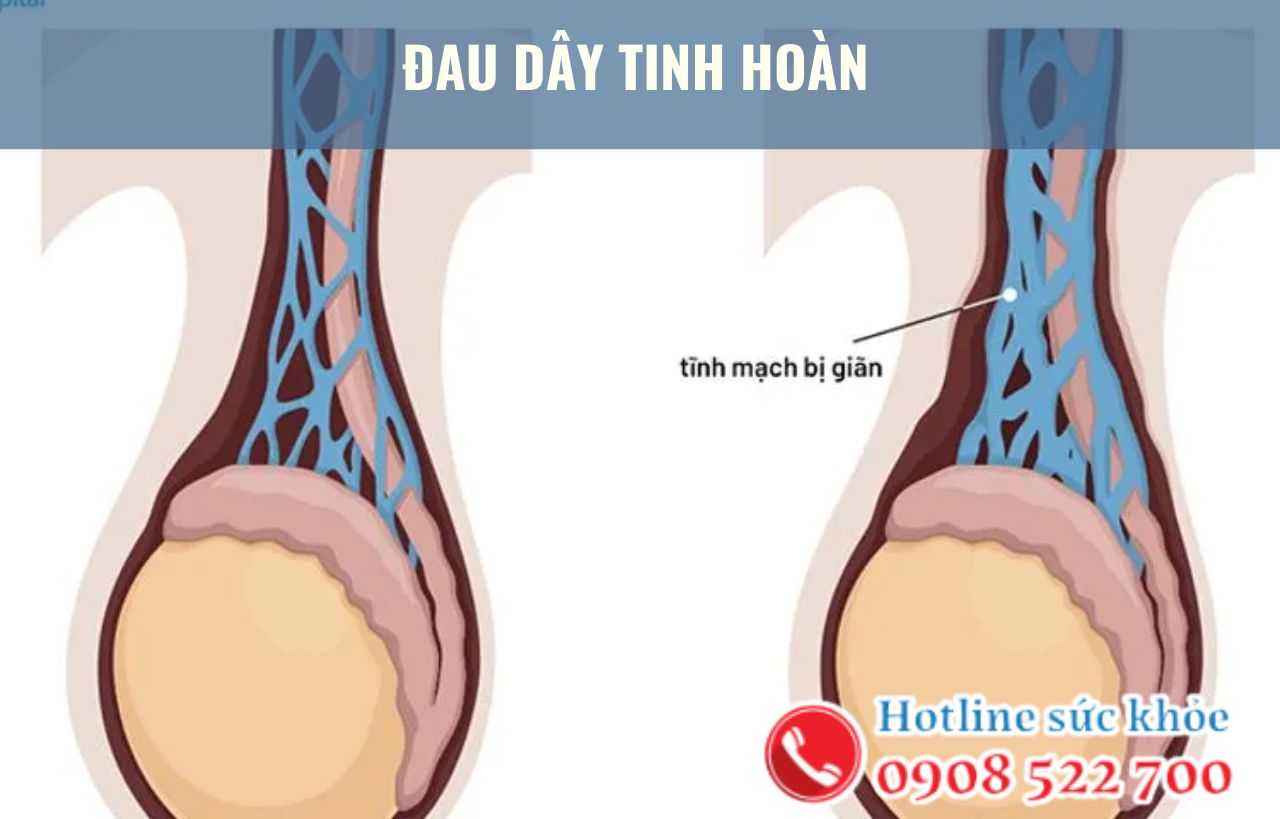 Đau dây tinh hoàn là bệnh gì?