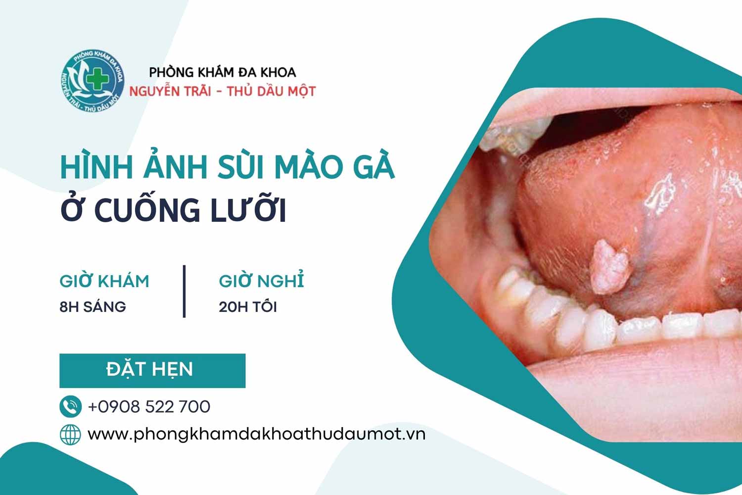 Hình ảnh sùi mào gà ở cuống lưỡi