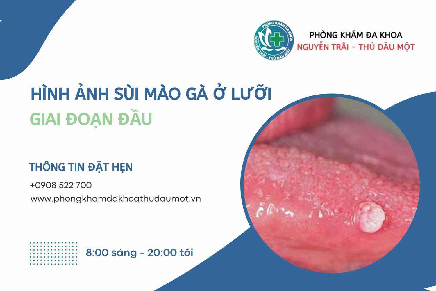 Hình ảnh sùi mào gà ở lưỡi giai đoạn đầu