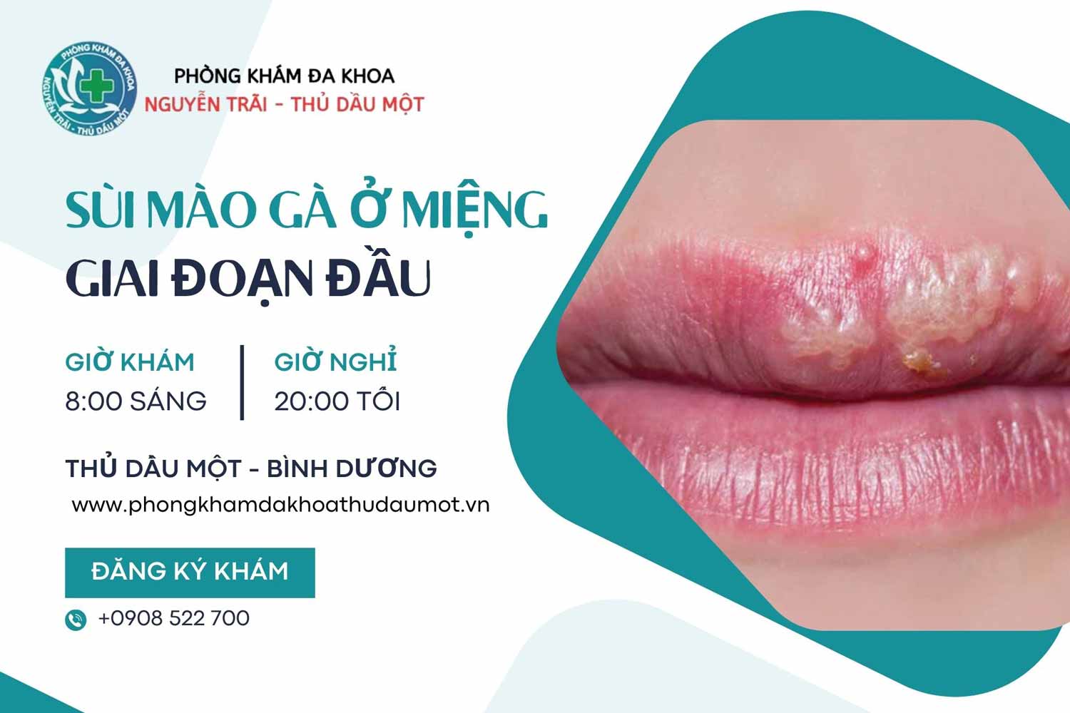 hình ảnh sùi mào gà ở miệng giai đoạn đầu