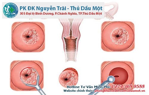 Phương pháp điều trị viêm tử cung - viêm lộ tuyến tử cung