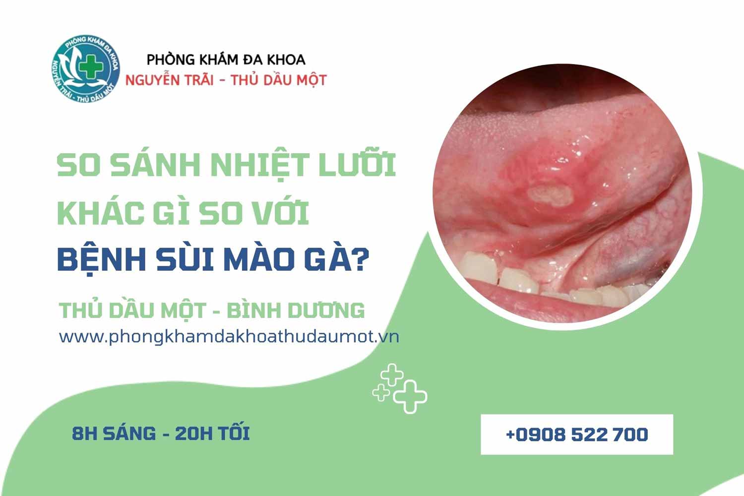 so sánh bệnh sùi mào gà và hình ảnh của chứng nhiệt lưỡi