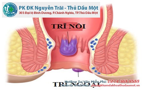 Bệnh trĩ nội là gì - Bác sĩ Đa khoa Nguyễn Trãi - Thủ Dầu 1