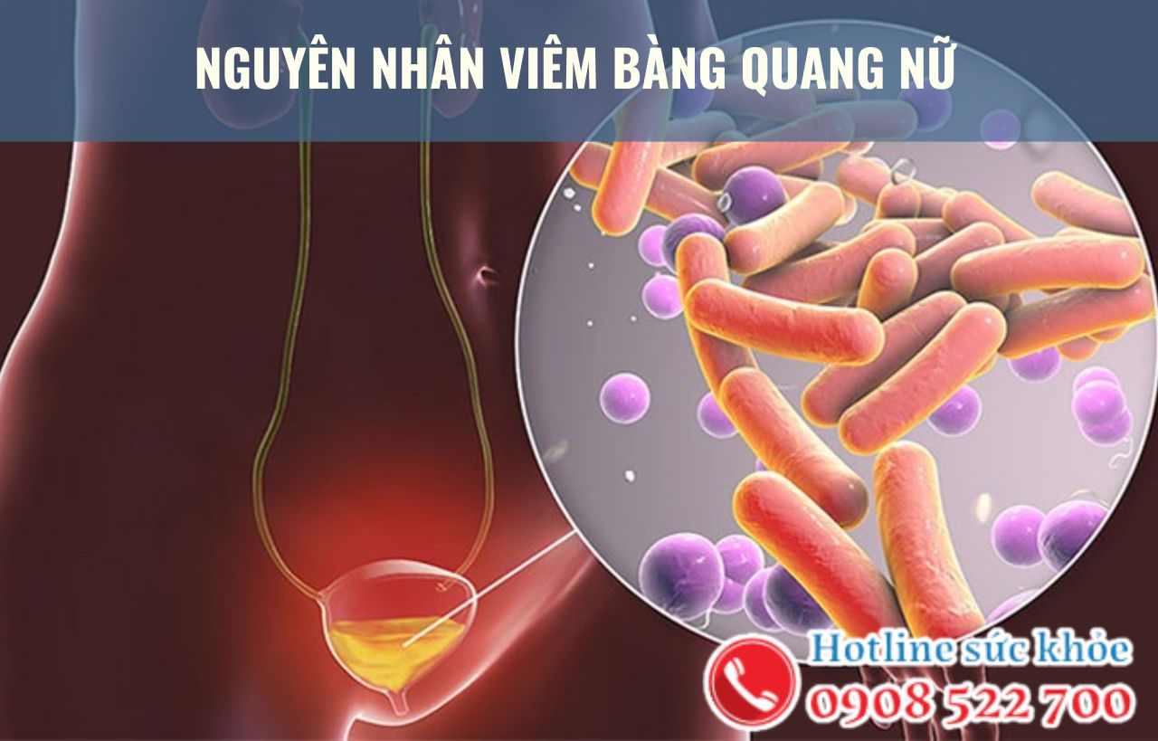 Nguyên nhân viêm bàng quang nữ gồm những yếu tố nào?