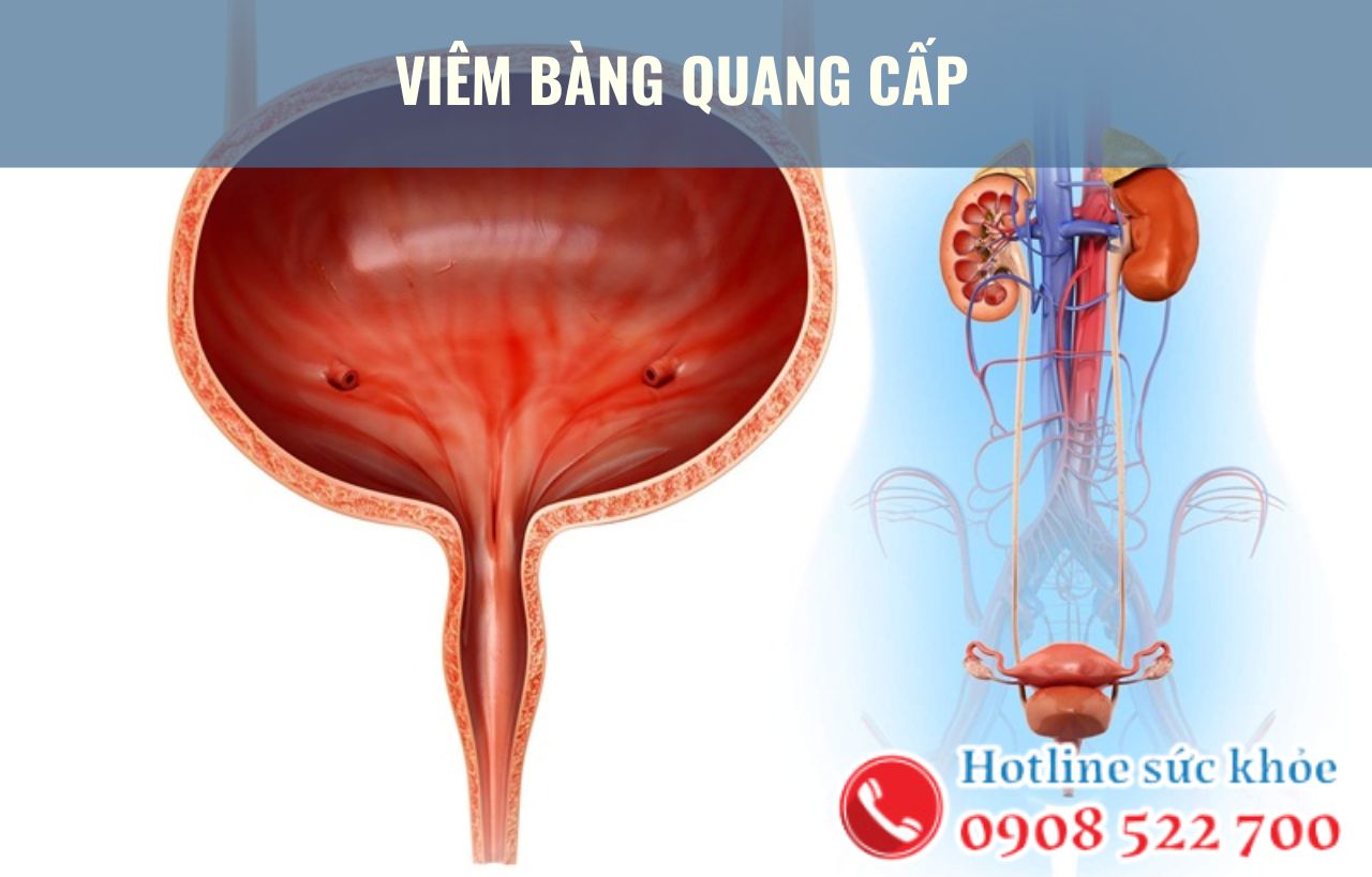 5 Điều cần biết về viêm bàng quang cấp