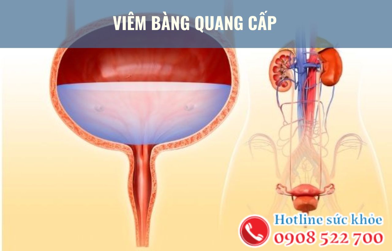 5 Điều cần biết về viêm bàng quang cấp