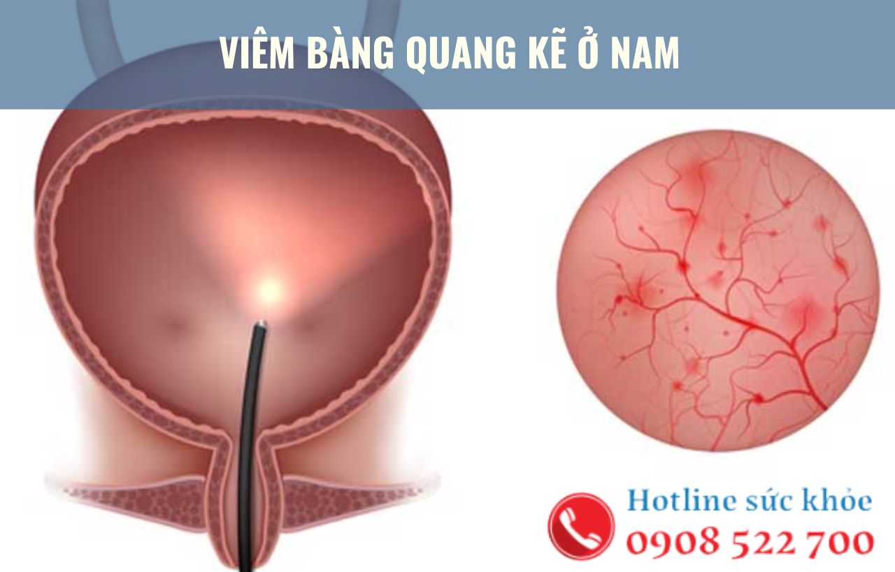 Viêm bàng quang kẽ ở nam giới nhận biết bằng cách nào?