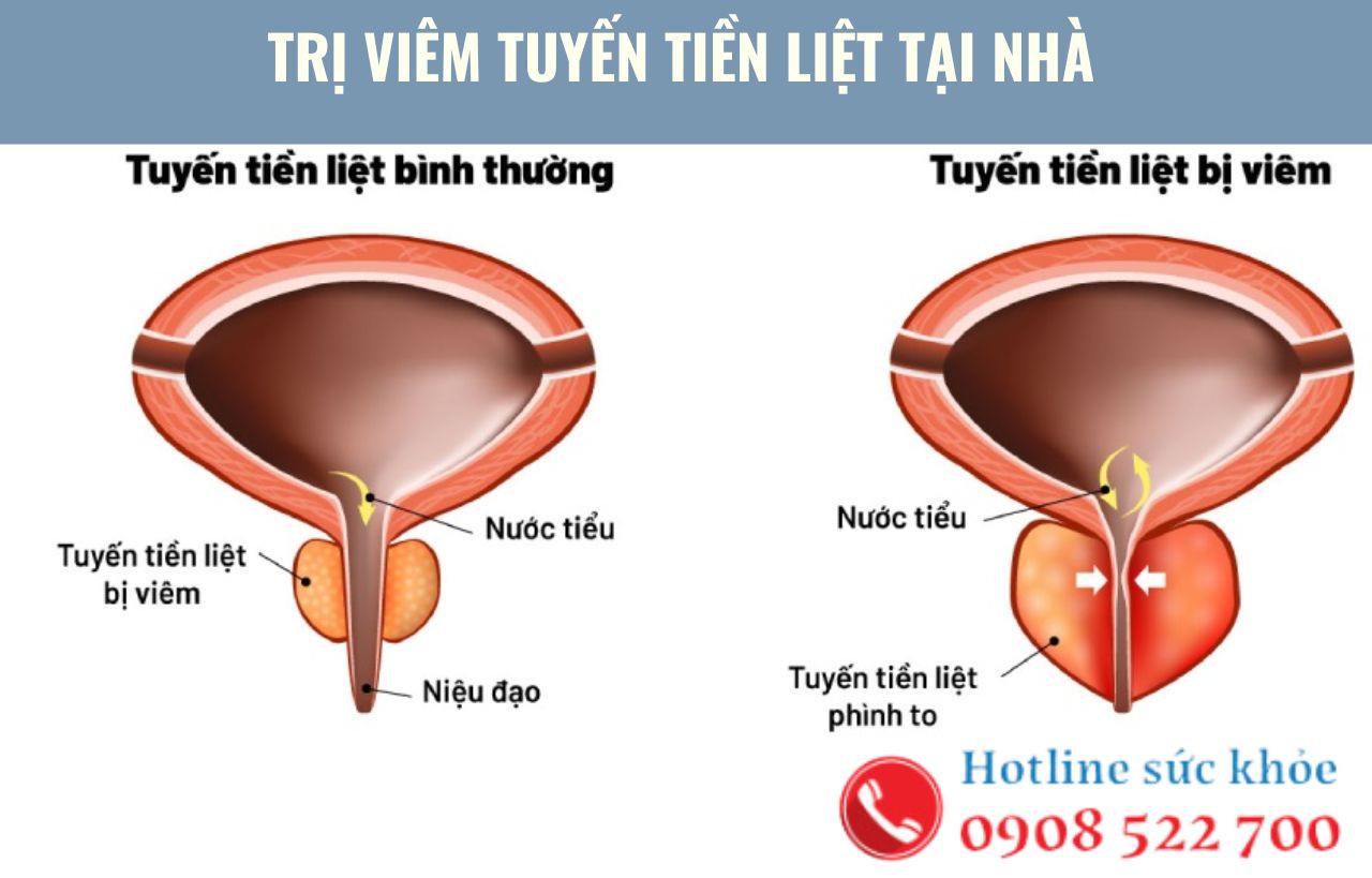 Trị viêm tuyến tiền liệt tại nhà bằng thảo dược