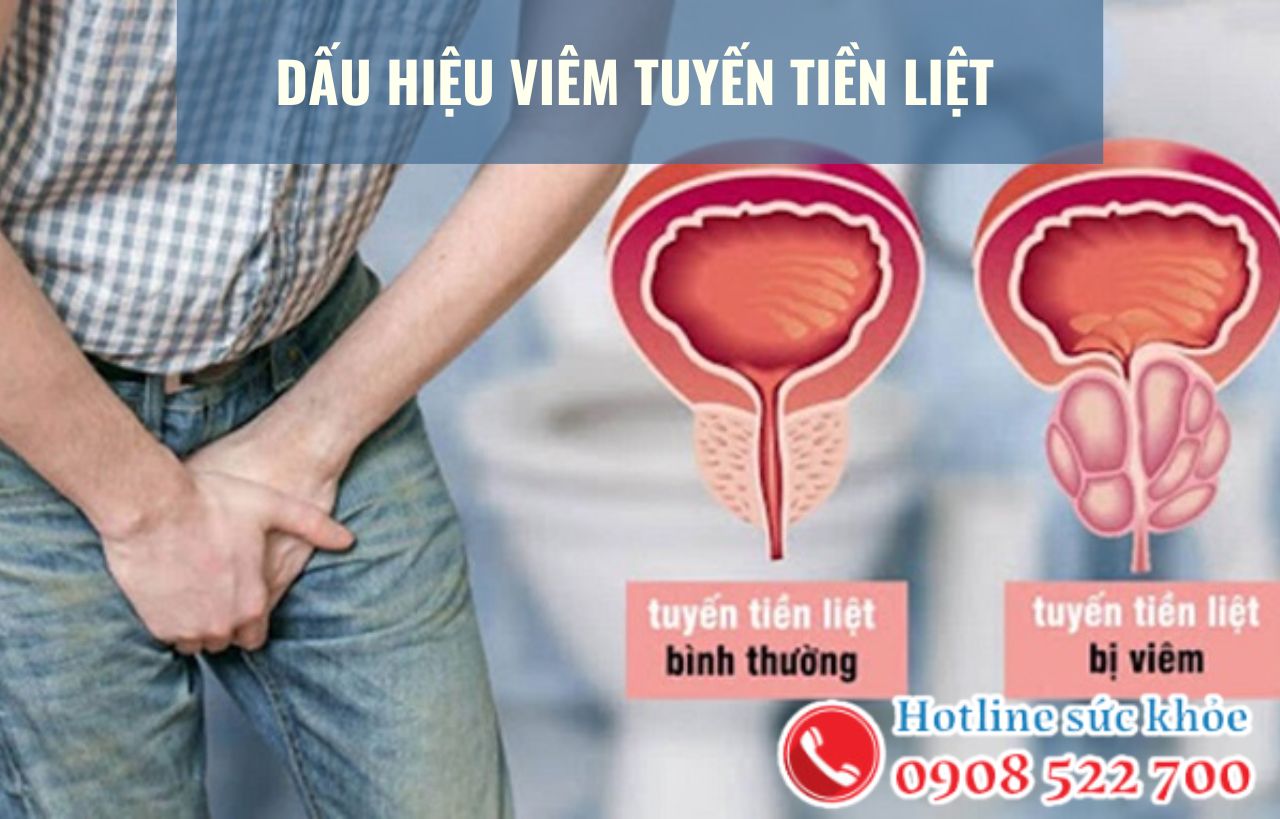 Dấu hiệu viêm tuyến tiền liệt đặc trưng ở nam giới?