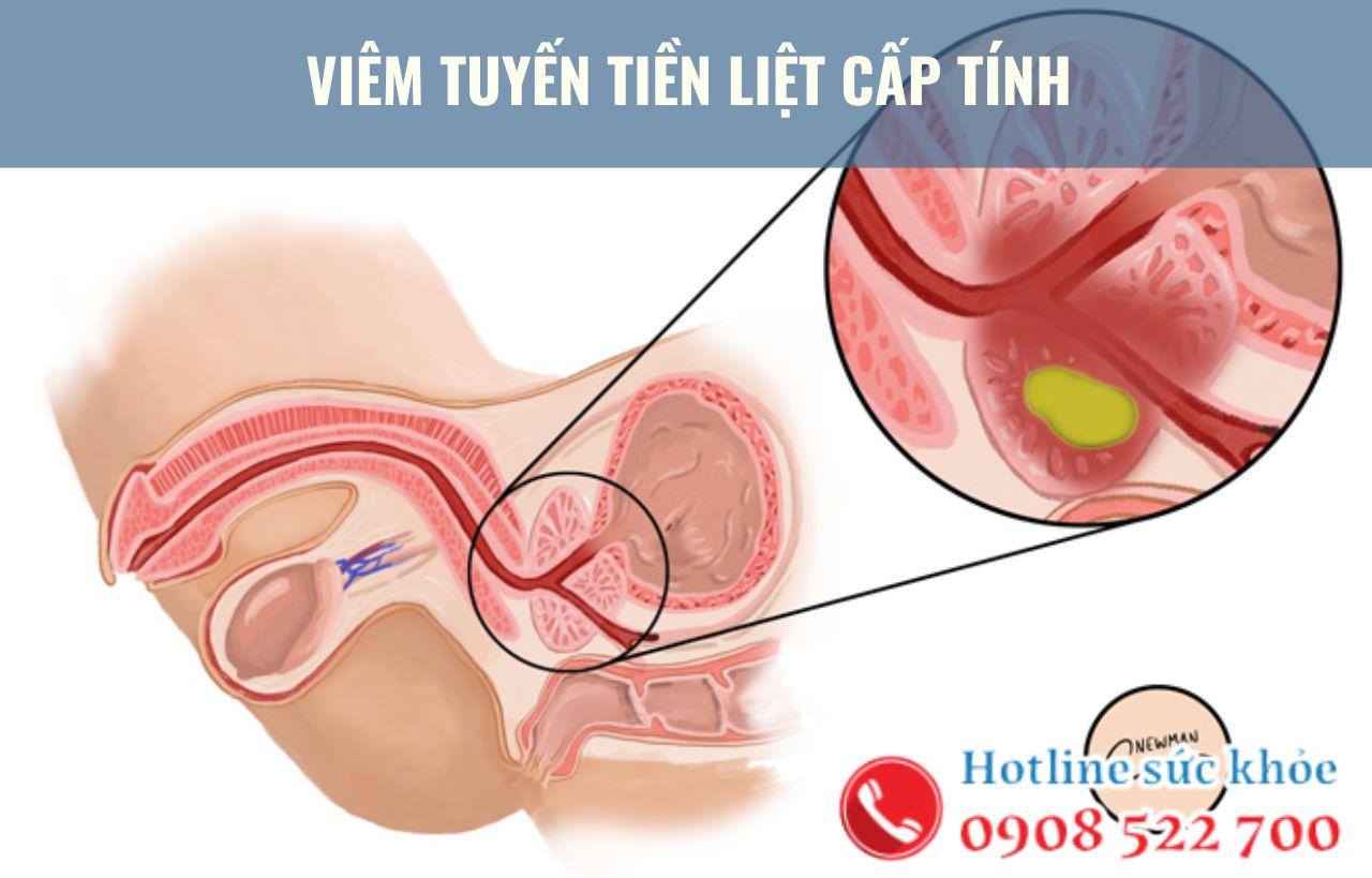 Viêm tuyến tiền liệt cấp tính có nguy hiểm không?