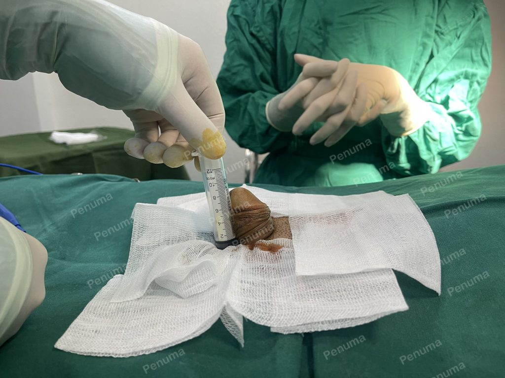 tăng kích thước dương vật