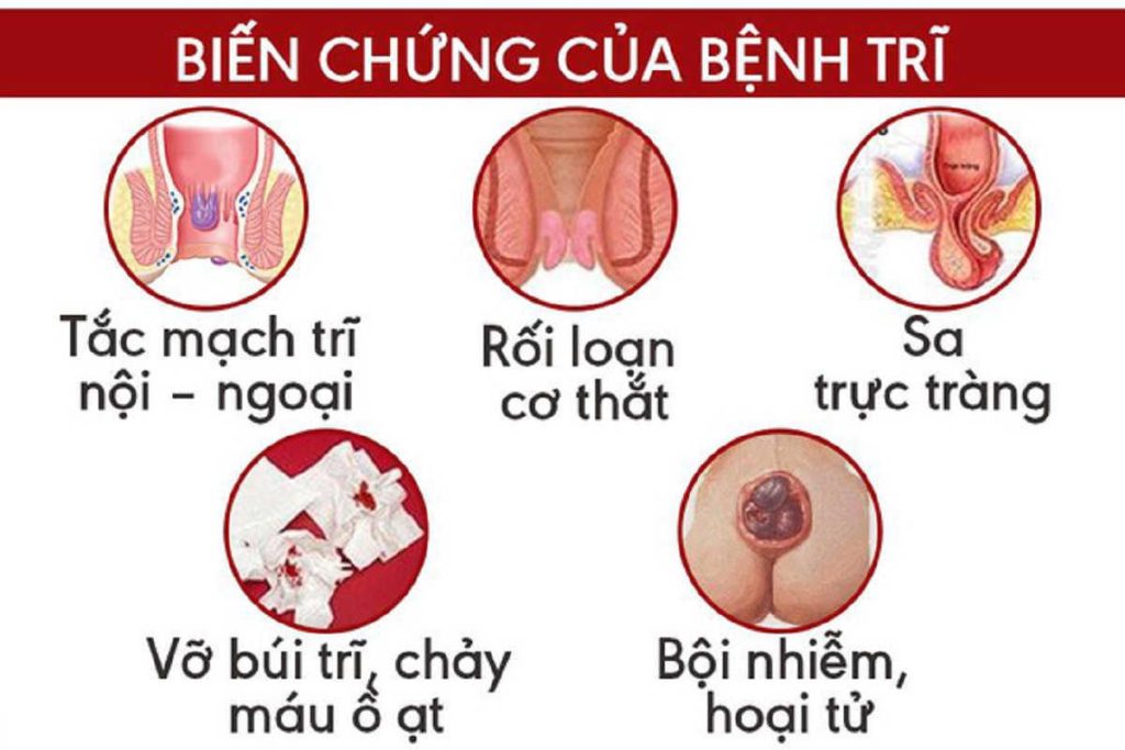 Hình ảnh minh họa bệnh lòi dom