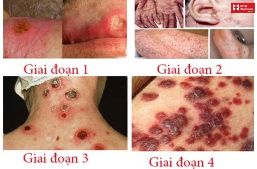 Thông tin chi tiết về điều trị giang mai tại nhà