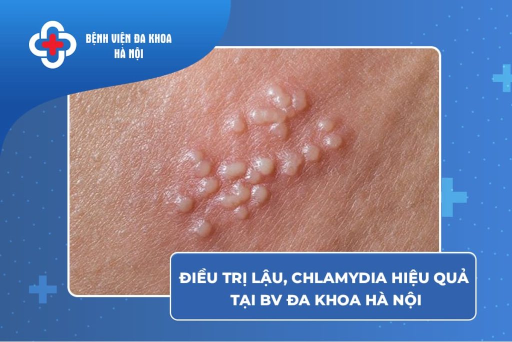 phác đồ điều trị chlamydia