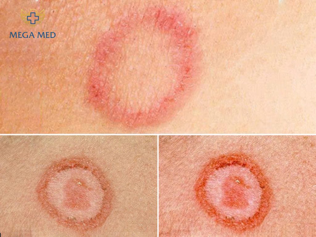 Thông tin chi tiết về hình ảnh giang mai giai đoạn 1