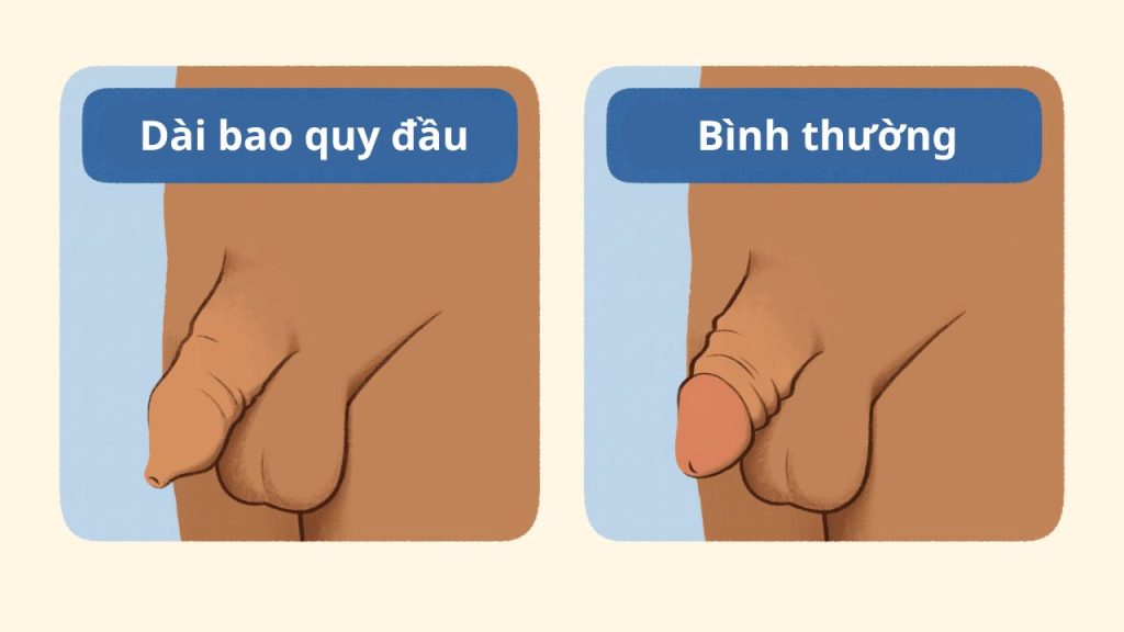 Thông tin chi tiết về không cắt bao quy đầu có quan hệ được không