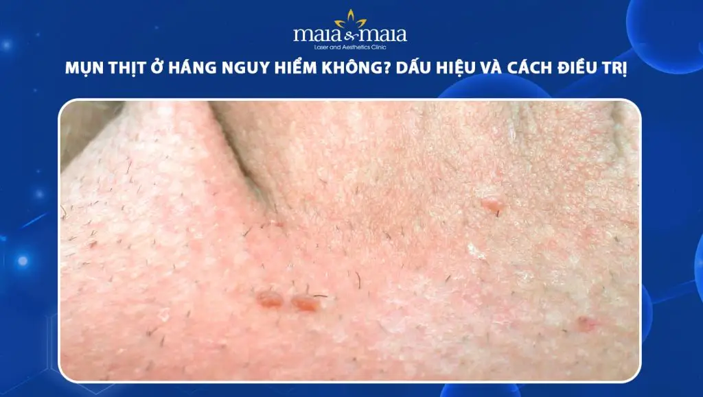 Thông tin chi tiết về nổi mụn thịt ở dương vật