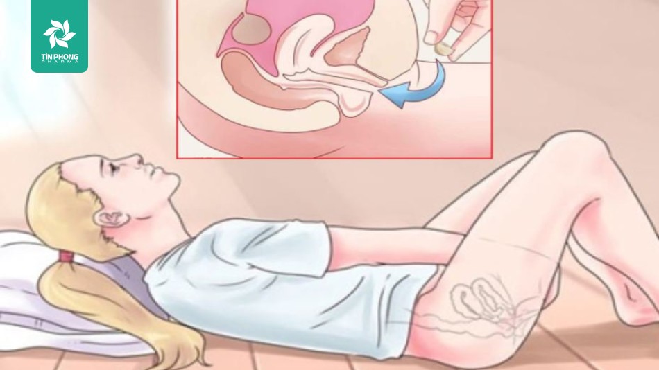 Hình ảnh minh họa đặt thuốc phụ khoa khi mang thai
