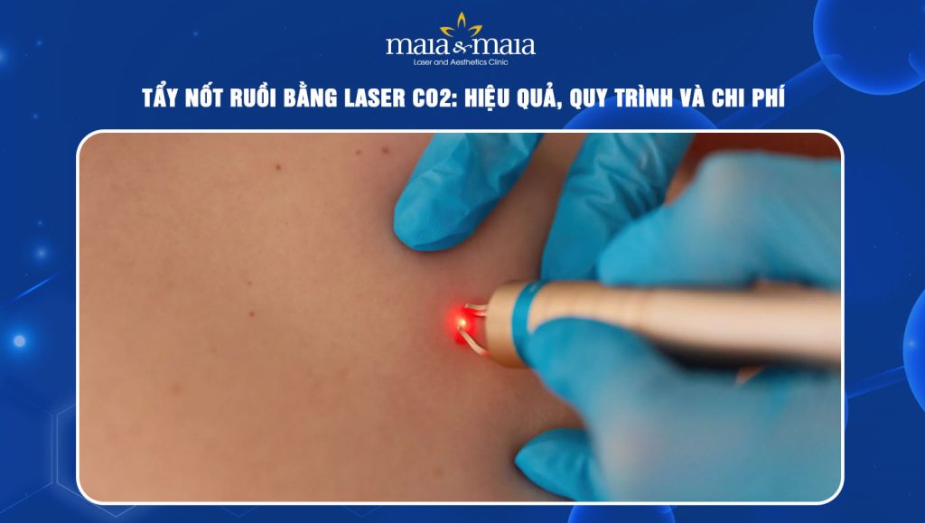 Hình ảnh minh họa tẩy nốt ruồi bằng laser