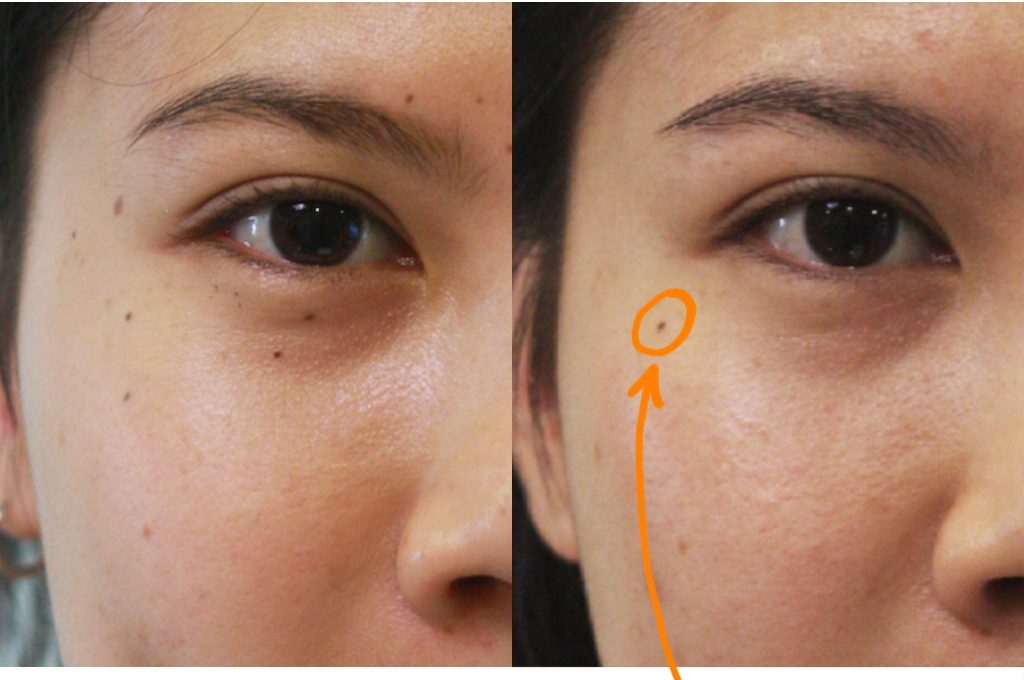 Thông tin chi tiết về tẩy nốt ruồi bằng laser