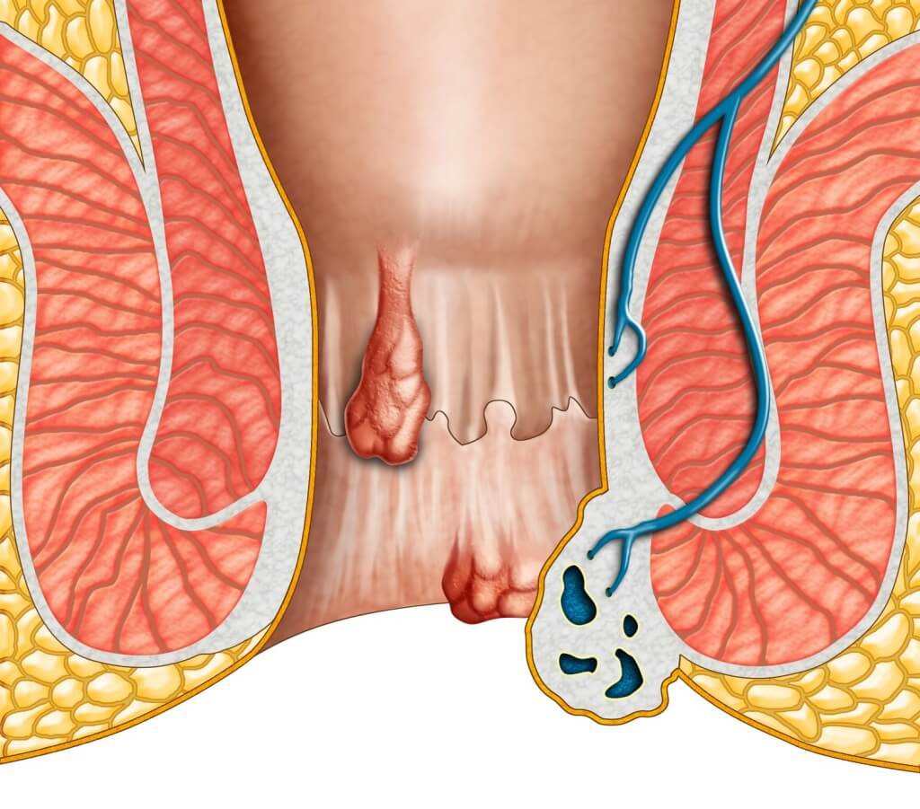 đại tiện ra máu