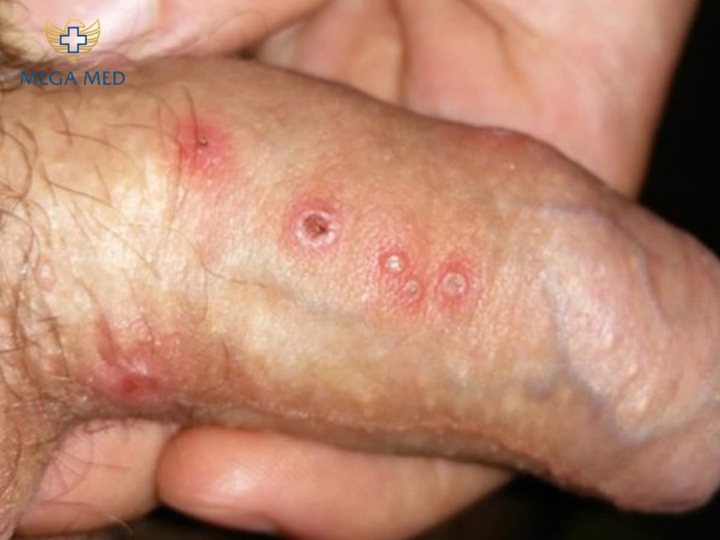 Hình ảnh minh họa herpes sinh dục