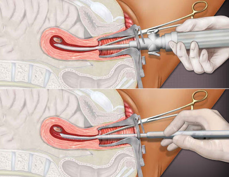 Hình ảnh minh họa hút thai gây mê tĩnh mạch